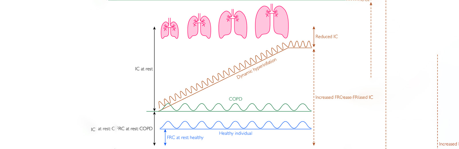 dynamic-hyperinflation-in-copd
