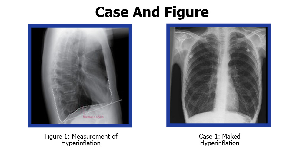 What is Hyperinflated Lungs and How to Manage it?