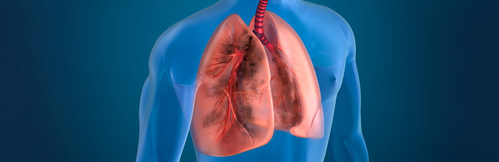 Understanding Multifocal Pneumonia: Symptoms And Causes